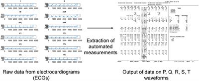 Automated Electrocardiogram Analysis Identifies Novel Predictors of Ventricular Arrhythmias in Brugada Syndrome